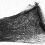 X-ray of a human radius showind the trabecular bone pattern