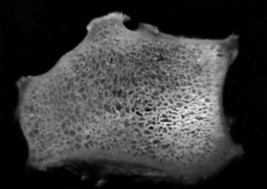 Section through the radius bone of a person without osteopenia, showing the dense trabecular network. Section through the radius bone of a person without osteopenia, showing the dense trabecular network.